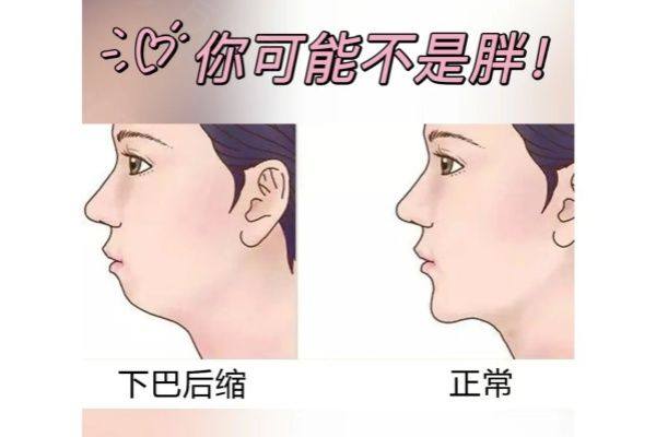 下巴后缩如何矫正？www.zgszw.com