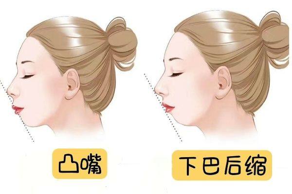 下巴后缩如何矫正？www.zgszw.com