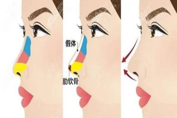 肋骨鼻和超肋的区别www.zgszw.com