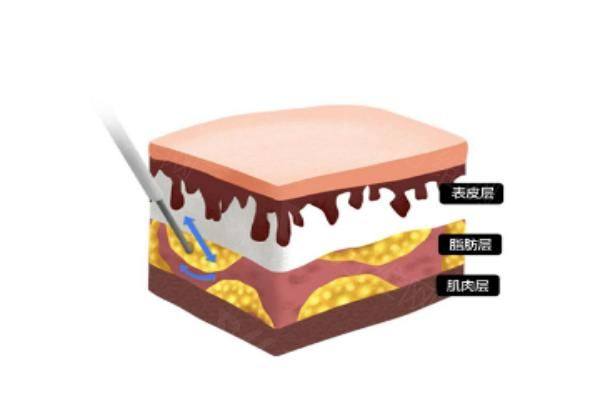 济南抽脂医院排名前十www.zgszw.com