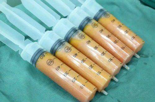 二、济南艺星整形医院收费贵吗?再看看其他项目的收费情况。