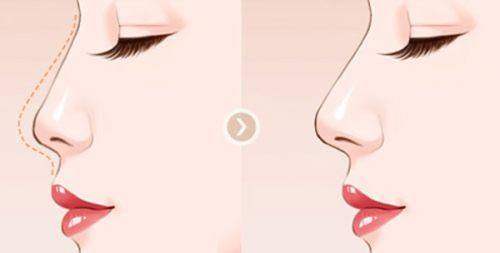 广州军美整形医院陈勇军收费一览表揭秘：双眼皮3800元起，隆鼻5800元起