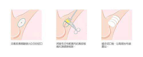 三、广州美莱医疗美容医院的鼻部多项整形特色