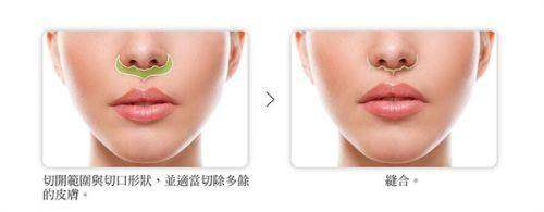 山东潍坊华韩整形人中缩短技术成熟吗？2025年众多案例证实其技术成熟