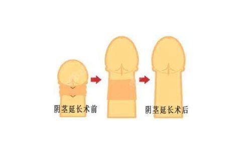 潍坊天宏医疗美容医院阴茎延长技术成熟吗？2025年多项临床案例证实其技术已达成熟水平！ 