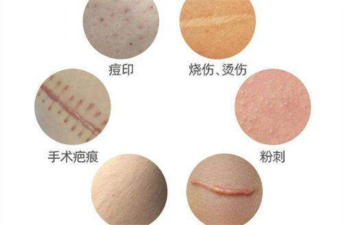 疤痕套餐