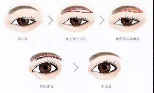 潍坊天宏医疗美容医院眉部整形真实案例分享，换眉形前后对比太绝了！