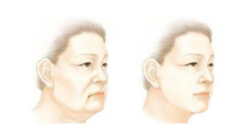 重庆肖林正颌手术效果怎么样？效果显著，患者容貌提升自信回归！ 