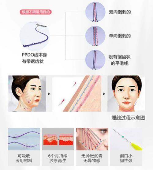 埋线提升套餐