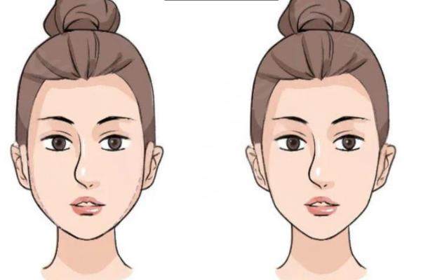 北京王阔远治疗馒化脸怎么样？真实患者亲测：术后脸型自然流畅效果超赞