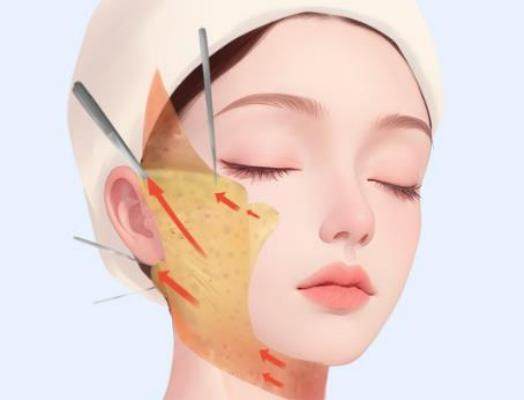 北京陈凤超医生做筋膜提升术怎么样？众多求美者亲测术后紧致效果超棒！