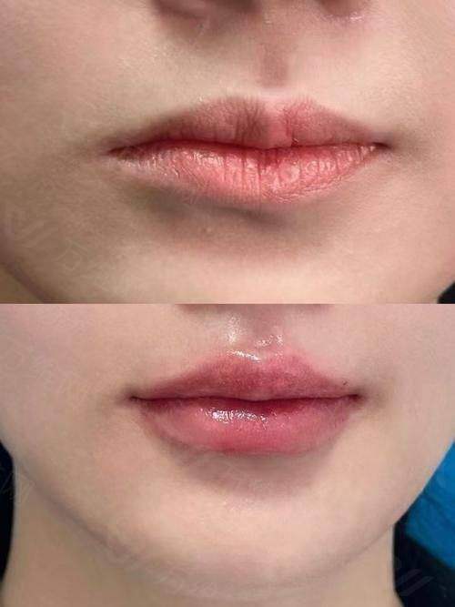 上海玻尿酸丰唇去哪个医院比较好？2025年口碑好的3家私立医院推荐