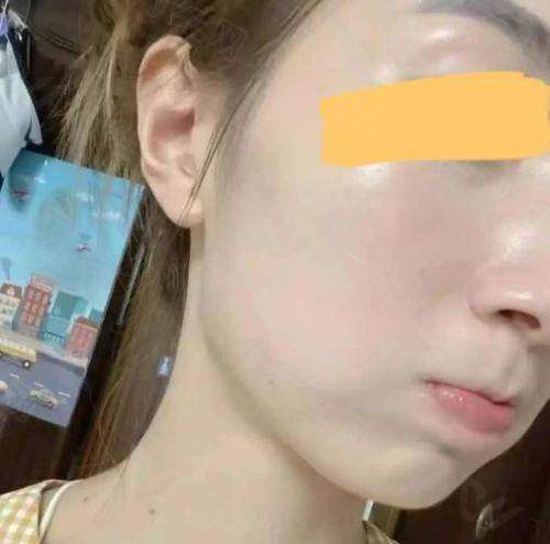 上海王丽珊祛痘印痘坑实例多吗？多种方案个性化治疗，成功案例丰富值得一试！ 