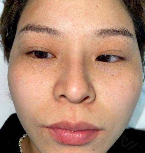 激光祛斑适合哪些人？面部黄褐斑、雀斑、日晒斑等人群或可尝试！ 