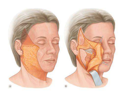 二、成都八大处隆鼻价格因手术难度不同而有别