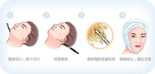 上海程开祥医生靠谱吗？技术优沟通细，男性私密整形值得选！ 