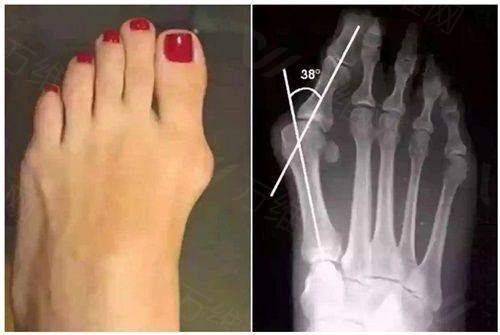 广州拉皮陈兵回落快吗？老牌医院名医操刀，效果持久性价比高！ 