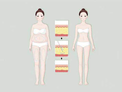 二、杜太超和袁强拉皮谁的费用高？简单回答一下杜太超和袁强拉皮谁的费用高