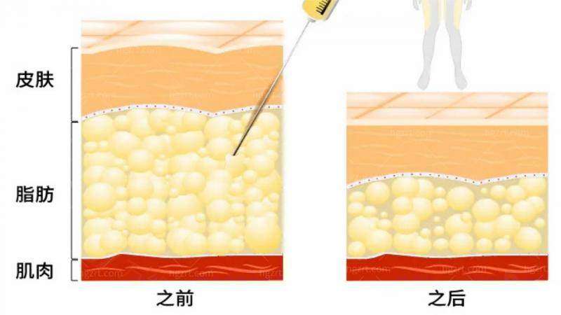 脂肪整形套餐