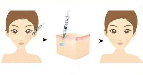 周敏茹医生脸上微调怎么样？众多爱美者亲测术后脸部线条自然流畅效果佳