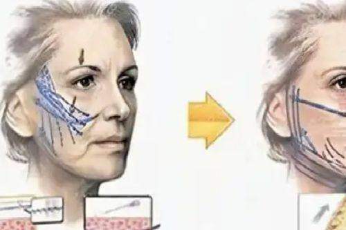 上海整形医生赵鹏筋膜提升靠谱吗？成功案例、技术优势全揭秘，答案超惊喜！ 