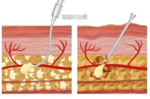 许佑勇医生做吸脂手术技术如何？众多求美者亲测，效果堪称惊艳，口碑超棒