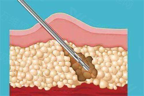 南京艺星医疗美容门诊部陈孝闯吸脂可信吗？真实顾客口碑：效果自然显著，陈孝闯吸脂技术值得信赖
