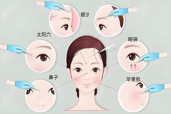 合肥韩美整形医院填补太阳穴效果咋样？采用先进填充技术塑造自然饱满面部轮廓