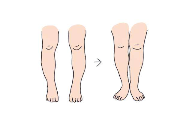 大腿吸脂后多久能跑步？深圳恒研定制恢复方案助您科学重返运动场