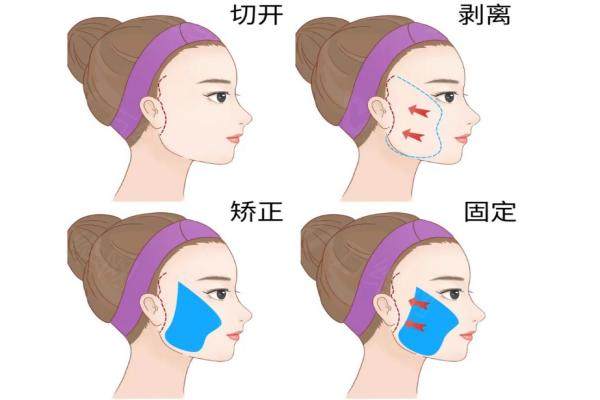 2026 宽下巴磨骨后脸会更方吗？长沙美研以新一代轮廓固定技术确保脸型精致稳定不反弹