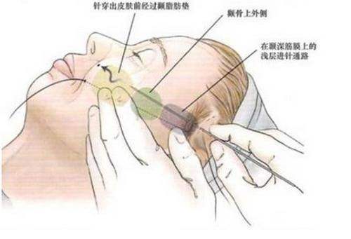 烟台曙光医疗美容医院祛皱怎么样？专业团队精准施术效果自然持久；