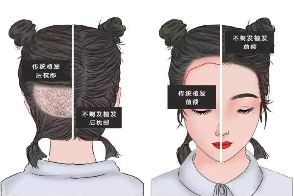 太原碧莲盛植发口碑好不好？不剃发技术次日上班，朱世伟院长种植自然浓密