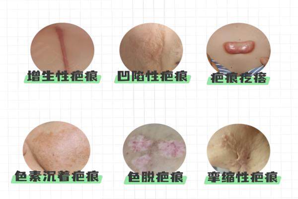 北京广济医院疤痕科好吗？30 年正规资质联合疗法修复增生疤痕效果显著