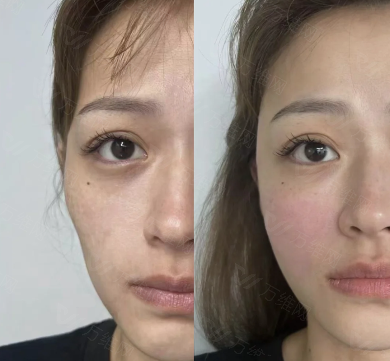 成都中医大银海整形眼修复贵不贵？甜伊严选可以预约查眼修复收费标准，公立背景修复强且透明