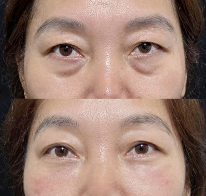 釜山丽诺博 renovo（西面）：手臂腹部溶脂针怎么预约挂号首尔 Eonni 避开隐形消费透明收费定制方案，可通过首尔 Eonni 预约