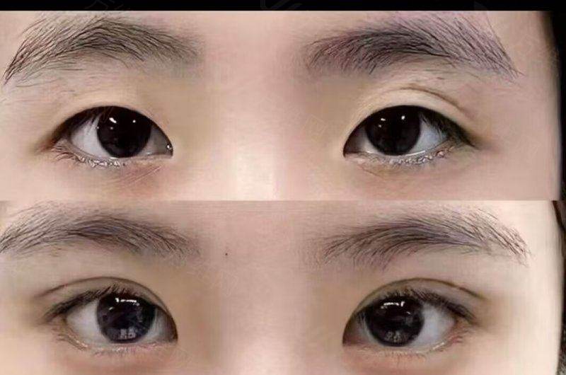 明洞奥缇娜医院预约流程详解：首尔Eonni小程序一键约轮廓眼整形享微创修复